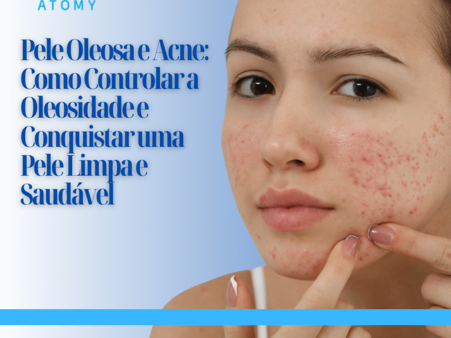 Pele Oleosa e Acne